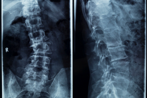 Scoliosis Treatment